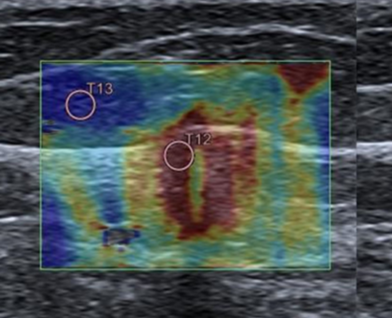 Shear wave elastography of the breast-histopathological comparisons